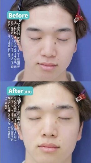Say goodbye to large moles with laser treatment!!