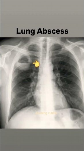 Chest-X- Ray view/Pneumothorax/ Pleural effusion/Lung abscess/ Hydropneumothorax/tuberculosis #short