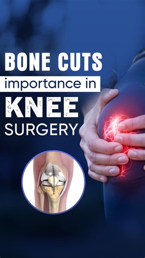 Sehgal Neo Hospital on Instagram: "Bone cuts in robotics involve using computer-assisted surgical systems, like those in total knee arthroplasty (TKA), to achieve superior precision in shaping bone for implants, moving beyond manual jigs for better alignment, stability, and patient outcomes, often using robotic arms guided by preoperative scans and surgical plans for highly accurate resections with minimal tissue damage. ⏺️How it works - Preoperative Planning: Surgeons use patient CT/MRI scans t