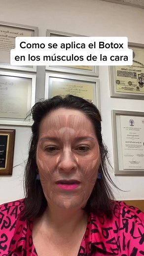Aplicación de Toxina Botulínica en los Músculos Faciales