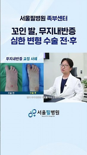 꼬인 발🫨 심각한 변형🙀 무지외반증 수술 부작용 사례👣