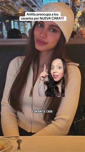 Anitta preocupa a los usuarios por NUEVA CARA‼️ #anitta #plasticsurgery