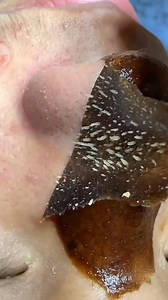 258K views · 1.1K reactions | Remove Blackheads & Whiteheads Naturally At Home . . . #blackheads #whiteheads #blackheadsremoval #whiteheadremoval #skincare #trendingreelsvideo #viralreelsシ #fbreelsfypシ゚ #reelsfypシ #fypシ゚viralシfypシ゚ #everyonefollowers | Natural Beauty Remedy | Facebook