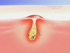 How Proactiv works on Acne and Pimples?