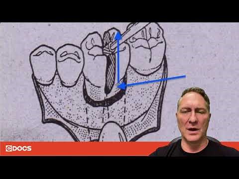 Tip of the Day: Sectioning Teeth for Oral Surgery