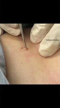 Dr Pimple Popper Shows Textbook Extraction Technique