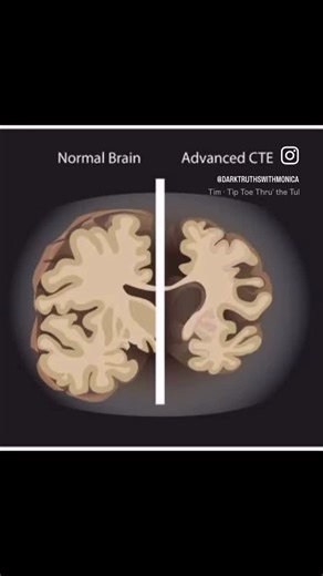Monica on Instagram: "In June 2007, police entered Chris Benoit’s Georgia home and found the unthinkable: his wife, Nancy, strangled… his 7-year-old son, Daniel, suffocated… and Benoit dead by suicide shortly after. The world blamed rage — until doctors examined his brain. They found severe CTE, trauma so advanced it looked like that of an 85-year-old Alzheimer’s patient. Decades of unprotected blows had shattered the very mind behind the legend. And that’s where the divide begins. Some say his 
