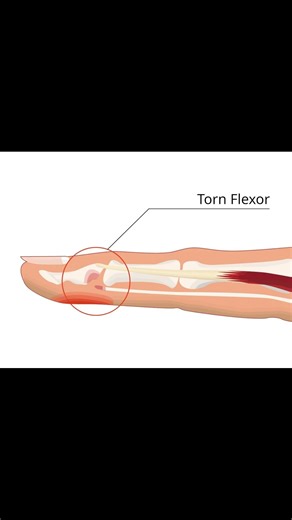 Jersey Finger Test 🏈 | FDP Tendon Injury Exam #meded #ATC #physio #ortho #physicalexam