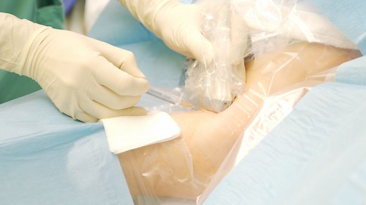 Axilläre Plexusanästhesie: So geht's