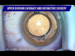Intraocular lens exchange after YAG capsulotomy w/placement of Vivity lens inside the capsular bag