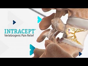Intracept Procedure (Overview)