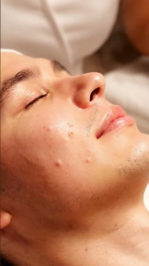 Gentle Acne Facial | Manual Whitehead Extraction with Tools.