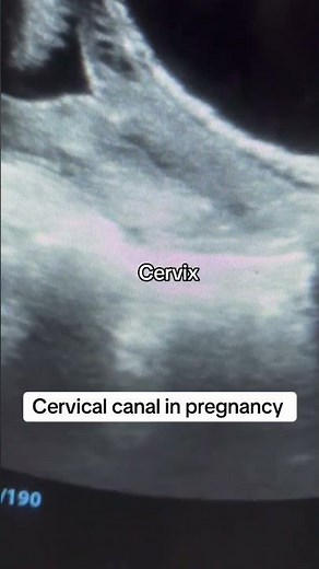 ￼￼Normal cervical length in ￼pregnancy |￼ awearness acording to ultrasound #students #sisterlogy