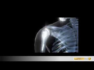 Schulterprothese: Endoprothetik bei Schulterbeschwerden