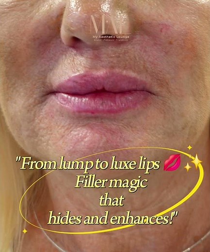 "From lump to luxe lips 💋✨ Filler magic that hides and enhances!"
