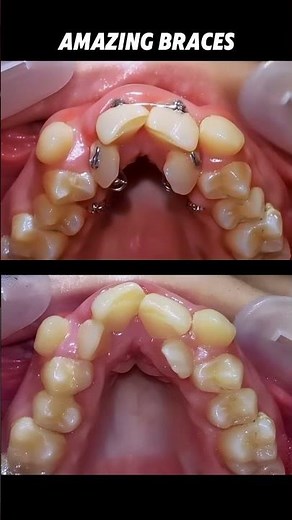 Amazing braces. Fix crowded teeth process #braces #orthodontist #dentist