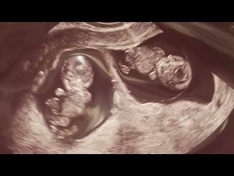 Nine Week Twin Ultrasound | Twin Pregnancy