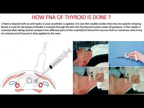 HOW TO PERFORM FINE NEEDLE ASPIRATION OF THYROID