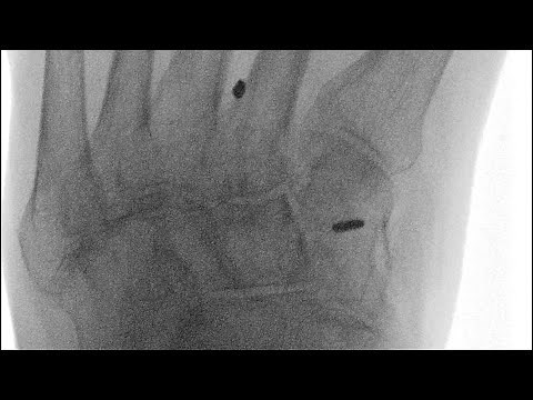 Knotless Mini TightRope® Fixation for Lisfranc Injuries