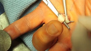 【扳机指手术实录】一刀松解A1滑车，手指瞬间恢复灵活！