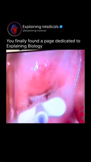 Medical | Health | Anatomy on Instagram: "A colposcopy is a simple, in-clinic procedure used to closely examine the cervix, vagina, and vulva for abnormal cells often after an abnormal Pap smear or HPV test. The procedure begins with you lying on an exam table, similar to a pelvic exam. A speculum is gently inserted to keep the vaginal walls open. The doctor then positions a colposcope (a special magnifying microscope) outside the body it never goes inside to get a clear, enlarged view of the ce