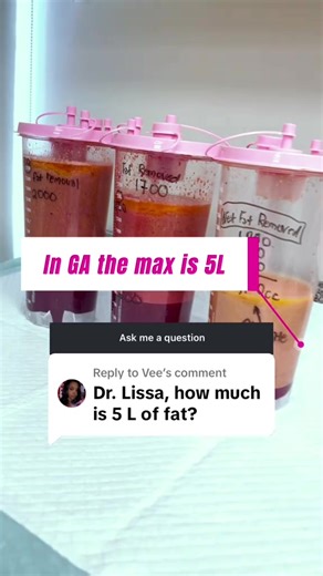In the state of Georgia, fat removal during liposuction is legally limited to 5 liters per procedure. This regulation is in place for patient safety. That’s why surgical planning matters. It’s not about removing the most fat — it’s about removing the right amount safely to create balanced, beautiful results. Safety. Strategy. Sculpting with intention. 💖 Book your consultation today www.drlissa.com or if you prefer texting? Reach out directly at 404-240-2804 #awakelipo #atlantaplasticsurgery #li