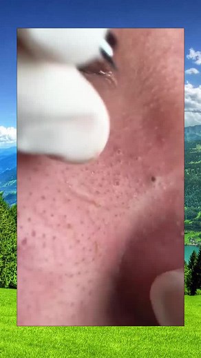 Effective Pore Extraction Techniques for Clear Skin