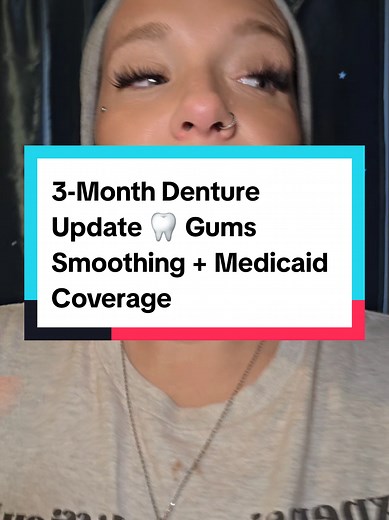 3-Month Denture Update: Gums Healing Progress