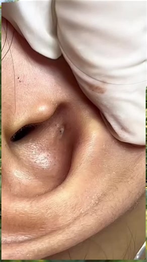 Blackhead in ear #acne #blackhead #pimple #blackheads #pimples #ear