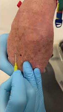 Another Difficult Cannula | #shorts #ivcannulation #anesthesiology #nurse