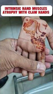 Neuropathy Examination | Step-by-Step Examination with Clinical Findings