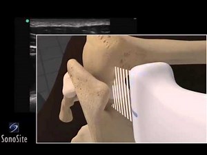 Démo 3D : infiltration écho-guidée de l'épaule par approche latérale - Échographe SonoSite