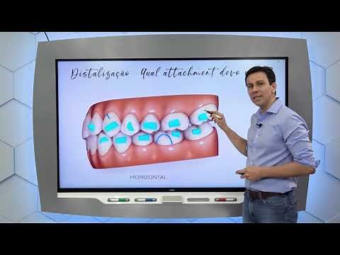 Aula 23 - Otimizando a distalização de molares com Invisalign