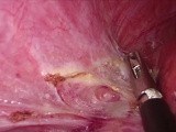 Laparoscopic Hydatid Cyst Excision Located in Segment 7 • Video • MEDtube.net