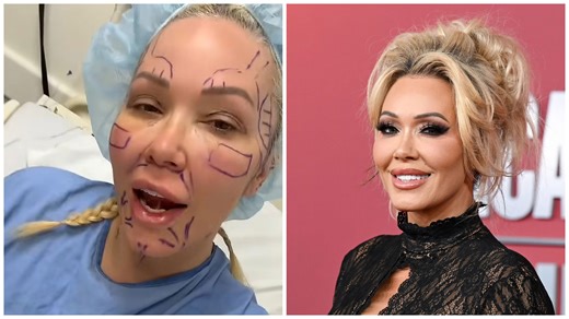 Jelly Roll’s wife shares dramatic before-and-after facelift photos