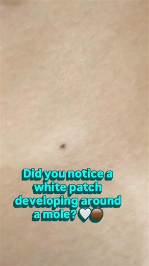 White Ring Around a Mole? Halo Nevus Explained | Is It Vitiligo? –Dr. Ashima Goel #parisaskinclinic
