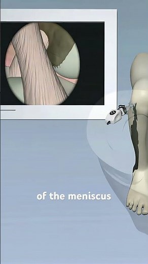 Meniscus Surgery 🦵Repair vs Meniscectomy explained. Meniscus tear surgery.(3D Animation)