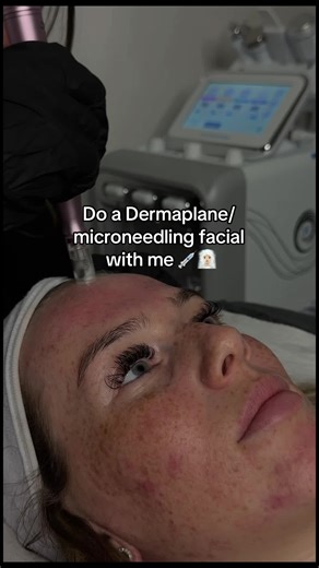 Dermaplane and Microneedling Facial Treatment Guide