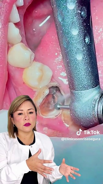 Tratamiento de Caries: Pasos y Consejos Esenciales