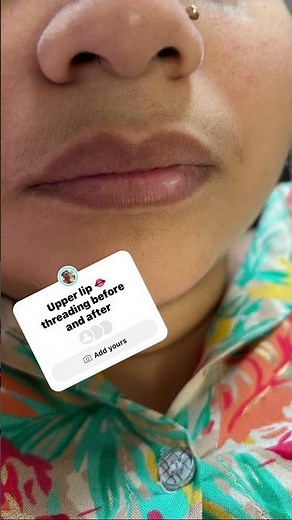 Upper lip 👄 threading before & after #upperliphairremoval #threading #beforeandafter#shortfeed
