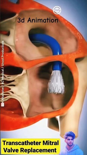 Transcatheter Mitral Valve Replacement (TMVR) #shorts #medical #3danimation