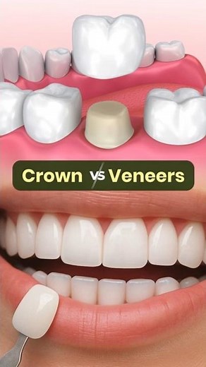 Veneers vs Crowns – Which Is Best for Your Teeth? 🦷 #dentistindore #veneers