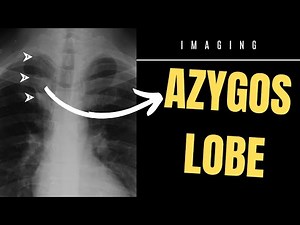 Azygos lobe 🫁 Anatomy - IN THREE 3️⃣ MINUTES ⌚