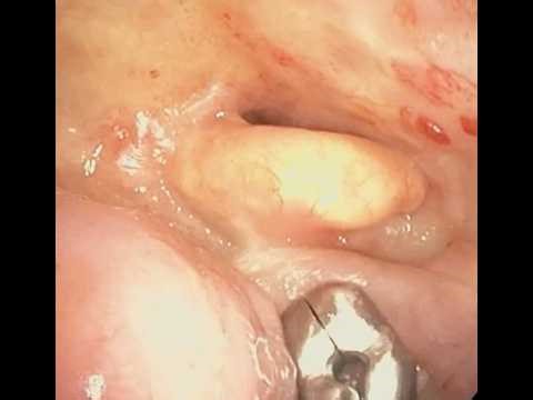 THRIVE in a very difficult airway patient from AOD