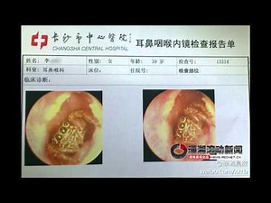 Spider Found Living In Woman's Ear