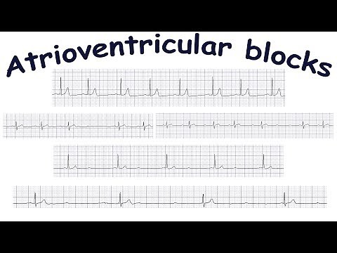Atrioventricular blocks