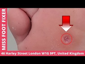 DEEP CORN EXTRACTION FULL TREATMENT BY MISS FOOT FIXER