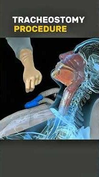 Tracheostomy procedure with Royalty song. ... #tracheostomy #medicaleduc