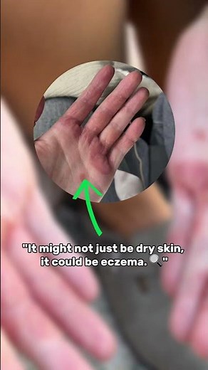 What Is Eczema Really? Dry, Itchy Skin Explained