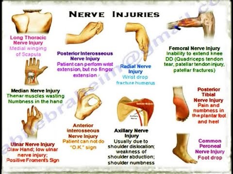 General types of peripheral nerve injury; Seddon's and Sunderland's Classification